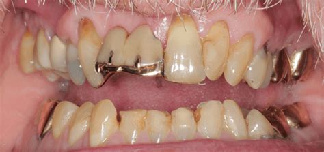 Using a Dental Bridge to Replace Front Missing Teeth - PureCare Dental