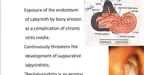 المدونة الطبية دفهيد سالم السبيعي Labyrinthine Fistula