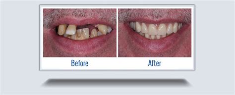 Extractions Burlington | Immediate Dentures | Waterdown Denture Clinic