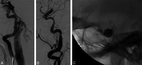 Case A And B Lateral Right Ica Angiograms Show The Ccf Before A