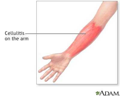 Cellulitis Symptoms, Doctors, Treatments, Advances & More | MediFind