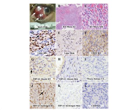 Comparative Visualization Of Kaposi Sarcoma Ks From The Ocular