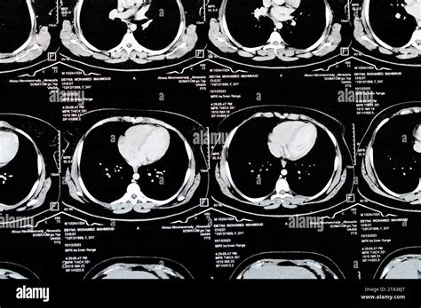 Cairo Egypt October 15 2023 Ct Scan Axial Slices Through Chest With Contrast Injection