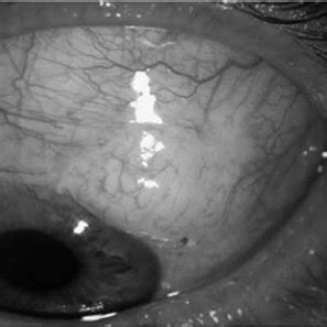 Filtering Bleb Of A Mitomycin C MMC Trabeculectomy 12 Months After