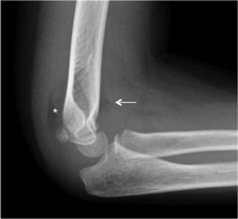 Posterior Fat Pad Sign Asterisk Is Specific To An Occult Elbow