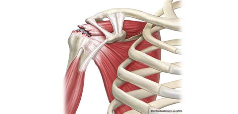 Shoulder Rotator Cuff Repair Trinay Orthopedic