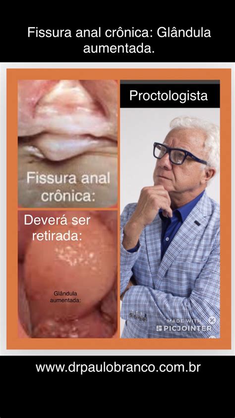Fissura Anal Evitar A Incontin Ncia Anal Saiba Na Consulta O M Dico