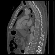 Sternal Fracture Radiology Reference Article Radiopaedia Org