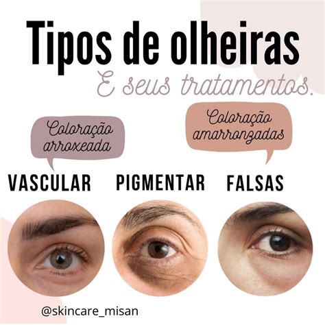 Tipos De Olheiras E Seus Tratamentos Olheiras Dicas De Beleza Tipos De