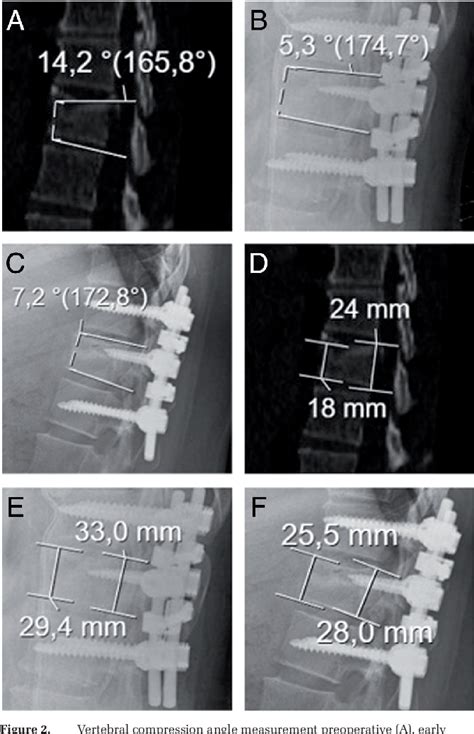 Table From The Effect Of The Size Of Pedicle Screw On The Long Term