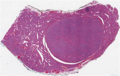 Non-invasive follicular thyroid neoplasm with papillary-like nuclear features | Atlas of Pathology