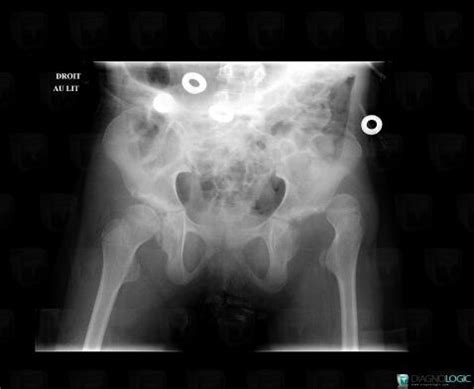 Radiology Case Congenital Hip Dislocation X Rays Diagnologic