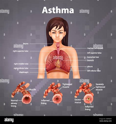 Comparison Of Healthy Lung And Asthmatic Lung Illustration Stock Vector