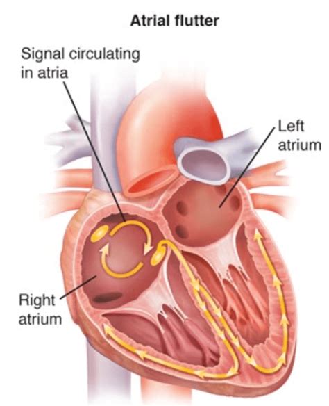 Atrial Flutter Ablation Rhythm And Cardiac Specialists