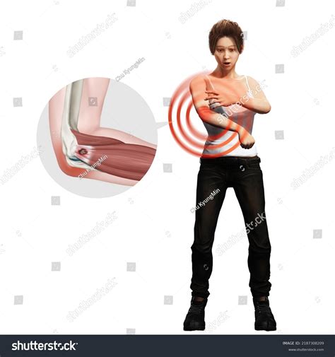 3d Medical Illustration Explain Tennis Elbow Stock Illustration