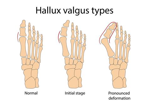 infographie médicale de l hallux valgus illustration vectorielle