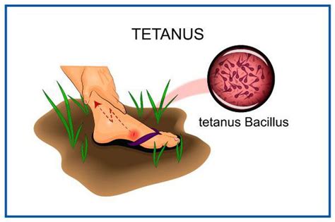 Tetanus Medizzy