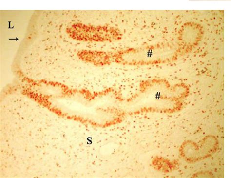 Figure 6 From Immunohistochemical Detection Of Estrogen And Progesteron