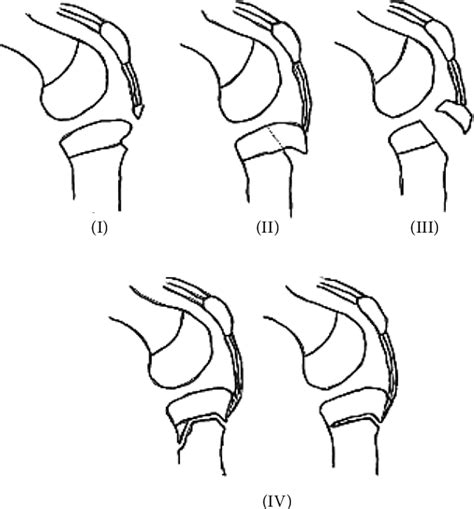 Figure 2 From Bilateral Simultaneous Avulsion Fractures Of The Proximal