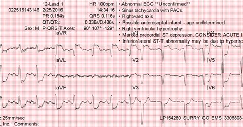 Dr Smiths Ecg Blog Diffuse Subendocardial Ischemia On The Ecg Left