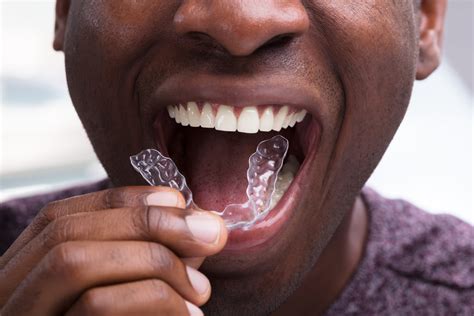 The Invisalign Treatment Process From Consultation To Retainers