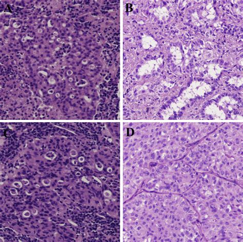 Pictures Of Cribriform Growth Pattern Common Acinar Growth Pattern