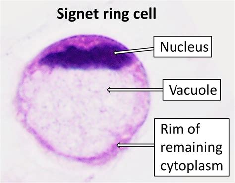 Signet Ring Cell Carcinoma Wikiwand