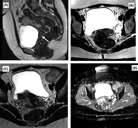 Tumor Visualization With Sagittal A And Axial B T2‐weighted Mr