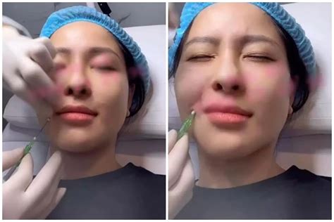 Hot girl Trâm Anh khoe cận cảnh tiêm mặt nhìn mà hãi Báo Tri thức và Cuộc sống TIN TỨC PHỔ