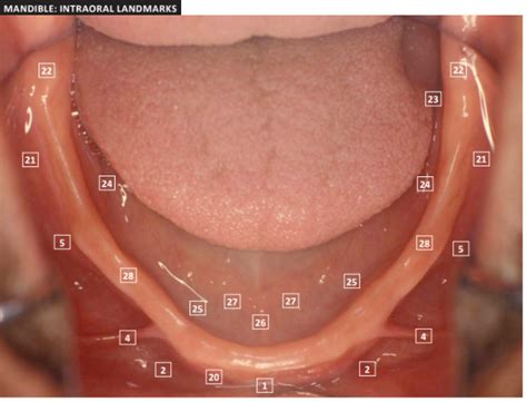 Efda Edentulous Mandible Intraoral Landmarks Diagram Quizlet