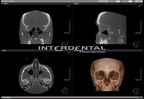 CBCT Tomografia Komputerowa W Stomatologii Radiologia Cyfrowa