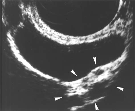 Endoscopic Ultrasonography For Differential Diagnosis Of Polypoid Gall