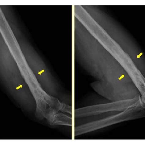 Wide Surgical Resection Of The Humerus Proximal Metaphysis Was