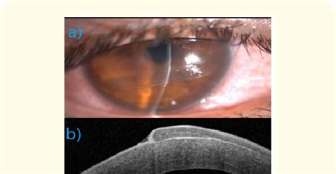 A Anterior Segment Photograph Showing Dislocated LASIK Flap In The