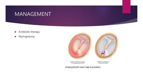 Mastoiditis | PPT