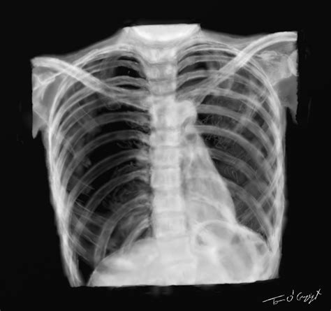 Pneumothorax Thoracotomie