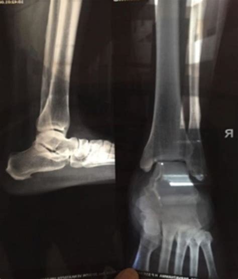 Calcaneal Spur Symptoms, Plantar Calcaneal Spur Treatment