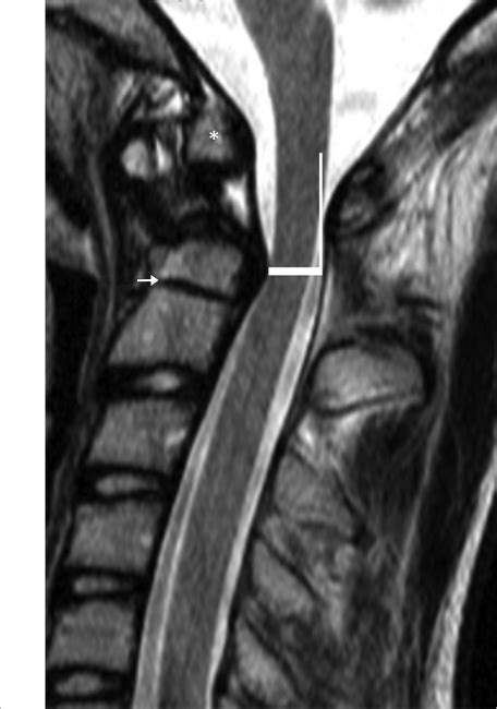 25 Os Odontoideum | Radiology Key