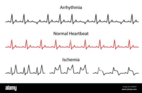 Normal Heartbeat Line