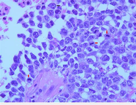 Diffuse large B-cell lymphoma with visible binucleated cell (black ...