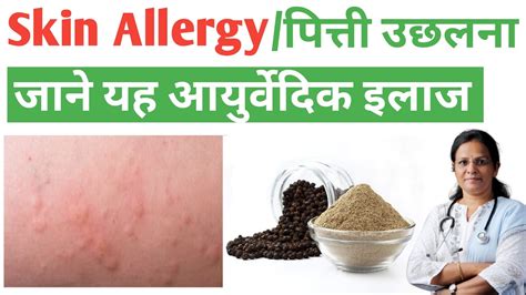 Skin Allergy Medicine Urticaria Pitti Ayurvedic