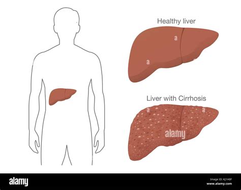 Cirrhosis Fotograf As E Im Genes De Alta Resoluci N Alamy