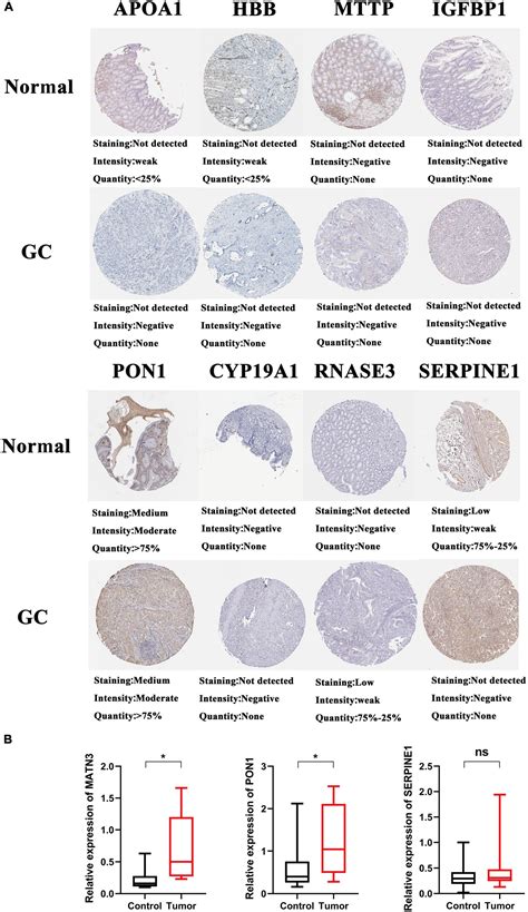 Frontiers Inflammation Related Genes Serve As Prognostic Biomarkers