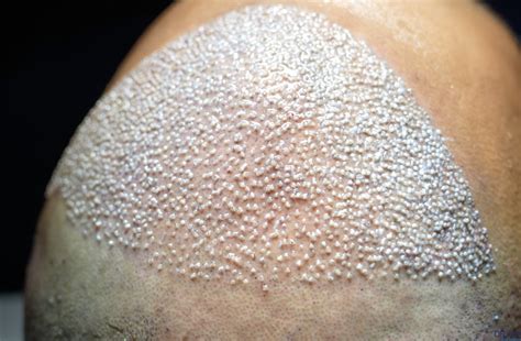 Gabriel Magalhães Hair Transplant Everything You Need To Know