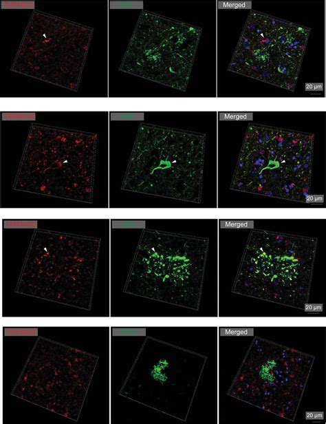 Double Immunofluorescent Staining Of TMEM230 And Phosphorylated Tau