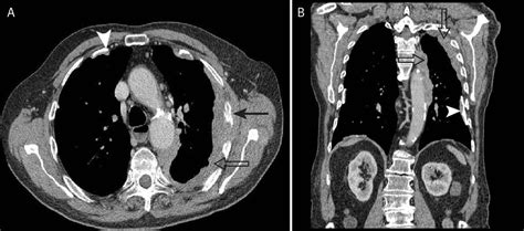 Investigating Pleural Thickening The Bmj