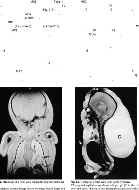 Figure 3 From Can Postmortem Fetal MR Imaging Replace Autopsy