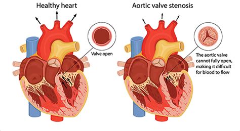 Understanding Aortic Disease | Knight Cardiovascular Institute | OHSU