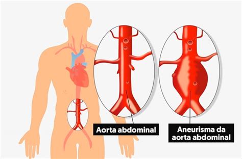 Aneurisma De Aorta Abdominal Causas Sintomas E Tratamentos