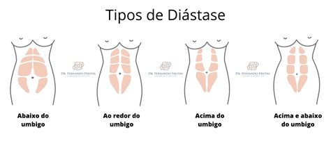 Diástase abdominal o que é e como tratar Dr Fernando Freitas